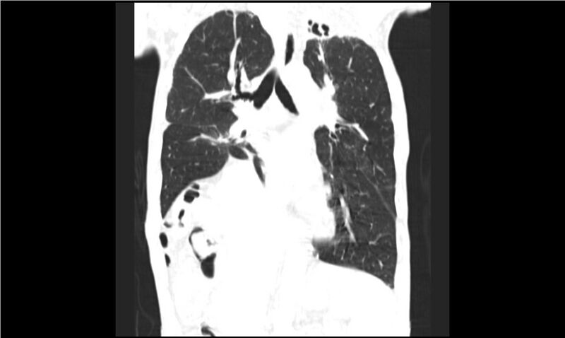 File:Aspergilloma (Radiopaedia 20788-20701 Coronal lung window 9).jpg