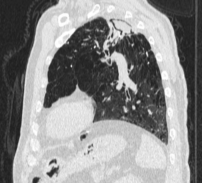 File:Aspergilloma (Radiopaedia 24521-24804 Sagittal lung window 1).png