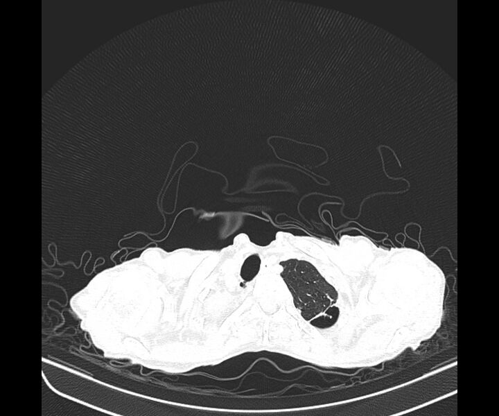 File:Aspergillomas (Radiopaedia 66779-76110 Axial lung window 10).jpg