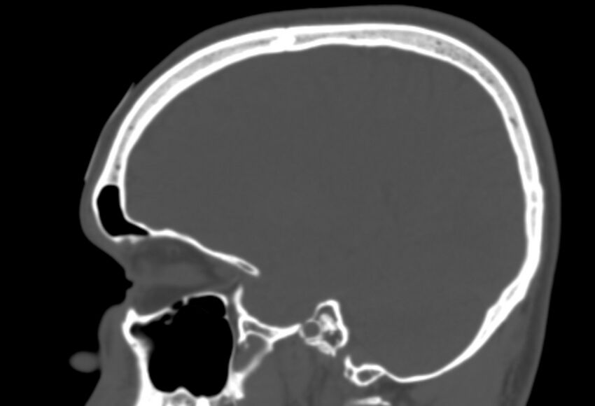 Asymptomatic occipital spur (Radiopaedia 87753-104201 Sagittal bone window 104).jpg