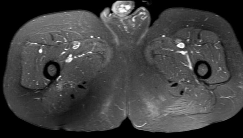 Atypical lipomatous tumor - thigh (Radiopaedia 68975-78734 Axial PD fat sat 72).jpg