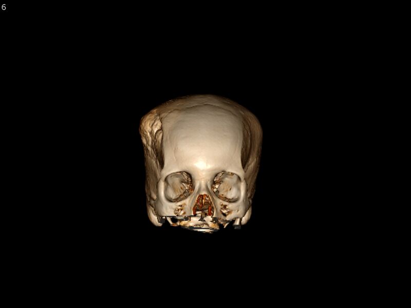 File:Atypical meningioma - intraosseous (Radiopaedia 64915-73867 3D volume render 6).jpg