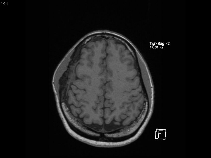 Atypical meningioma - intraosseous (Radiopaedia 64915-74572 Axial T1 144).jpg