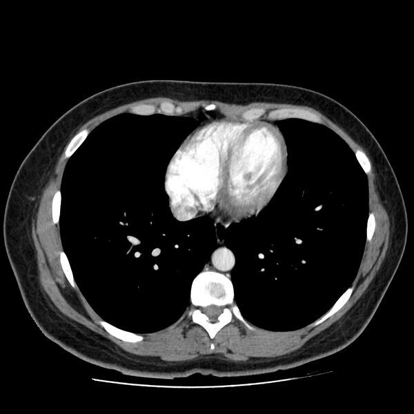 File:Autosomal dominant polycystic kidney disease (Radiopaedia 23061-23093 B 1).jpg