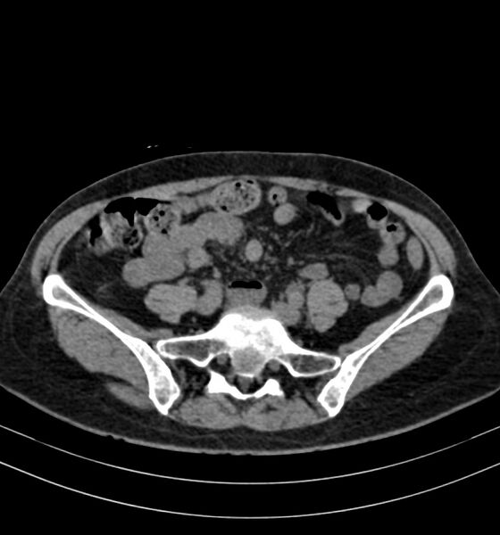 File:Autosomal dominant polycystic kidney disease (Radiopaedia 41918-44922 Axial non-contrast 24).jpg
