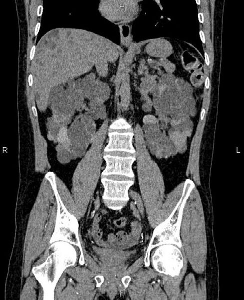 File:Autosomal dominant polycystic kidney disease (Radiopaedia 87830-104287 Coronal non-contrast 35).jpg