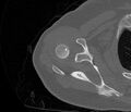 Avulsion fracture - greater tuberosity of humerus (Radiopaedia 71216-81514 Axial bone window 26).jpg