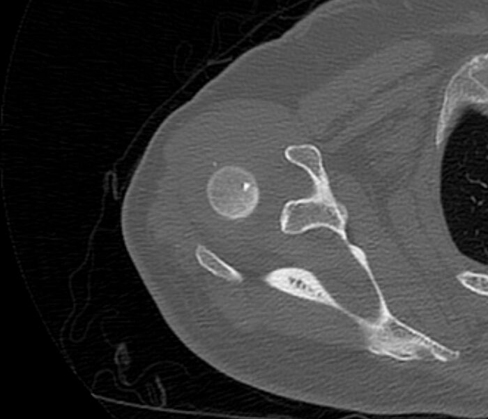 File:Avulsion fracture - greater tuberosity of humerus (Radiopaedia 71216-81514 Axial bone window 26).jpg
