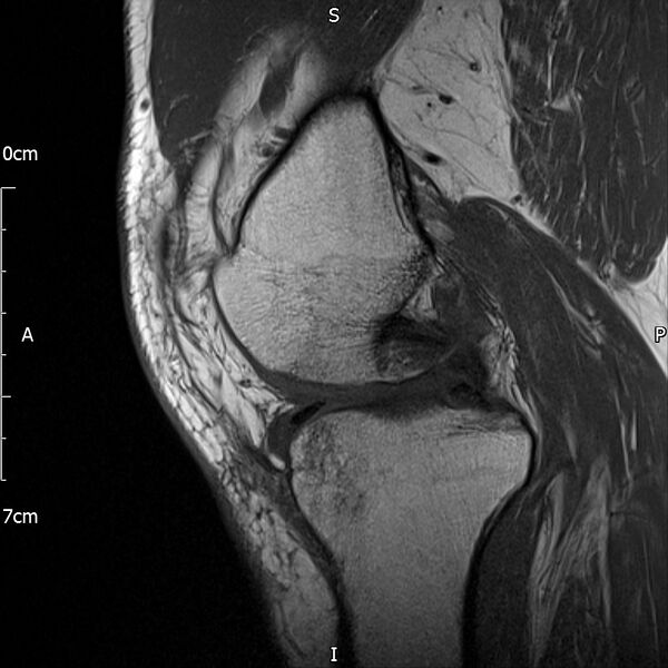 File:Avulsion fracture of the fibular head (Radiopaedia 74804-85808 D 14).jpg