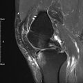 Avulsion fracture of the fibular head (Radiopaedia 74804-85808 Sagittal PD fat sat 14).jpg