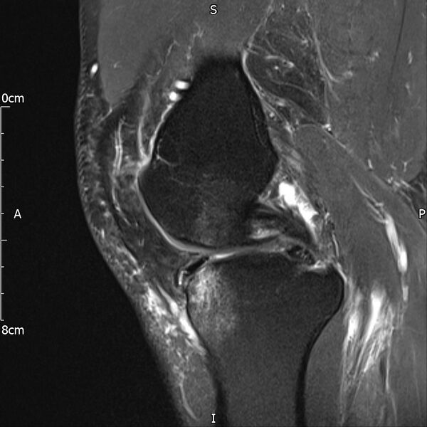File:Avulsion fracture of the fibular head (Radiopaedia 74804-85808 Sagittal PD fat sat 14).jpg