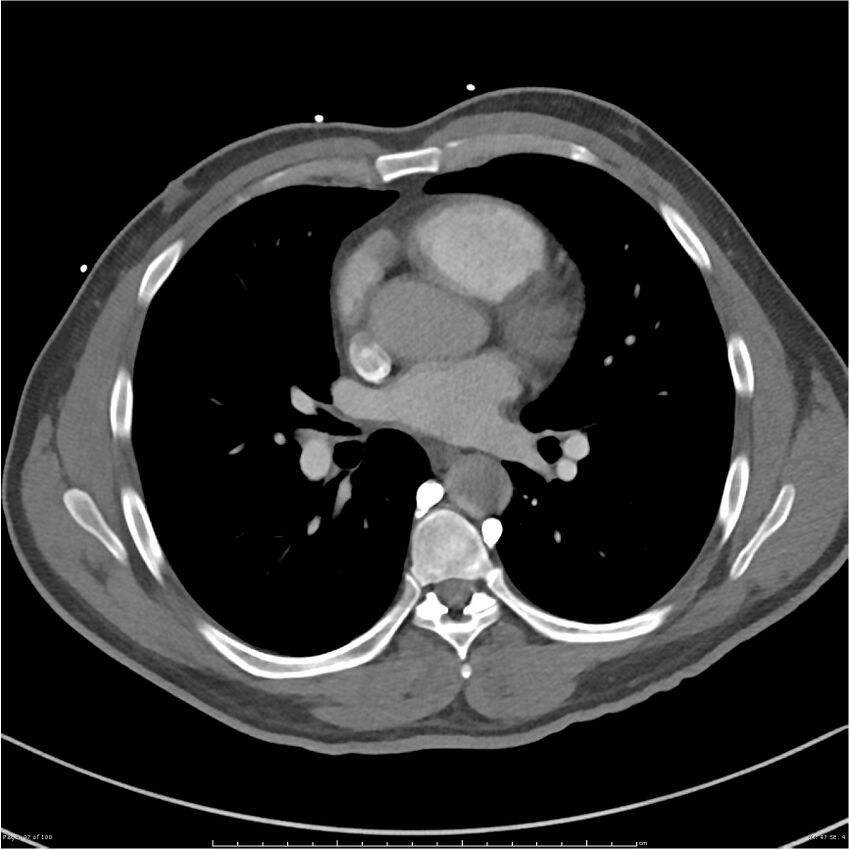 Azygos venous system anatomy (CT pulmonary angiography) (Radiopaedia 25928-26077 Axial C+ CTPA 47).jpg