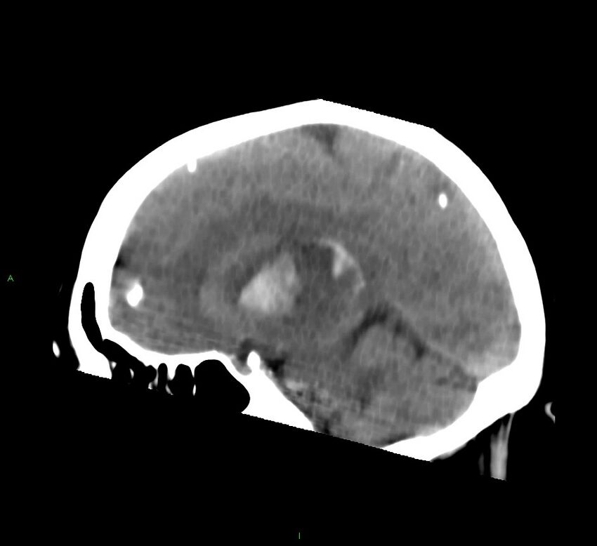 Basal ganglia hemorrhage (Radiopaedia 58759-65981 C 39).jpg