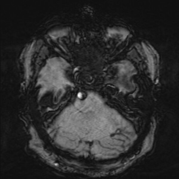 File:Basilar artery dissection (Radiopaedia 77032-88976 Axial SWI 15).jpg