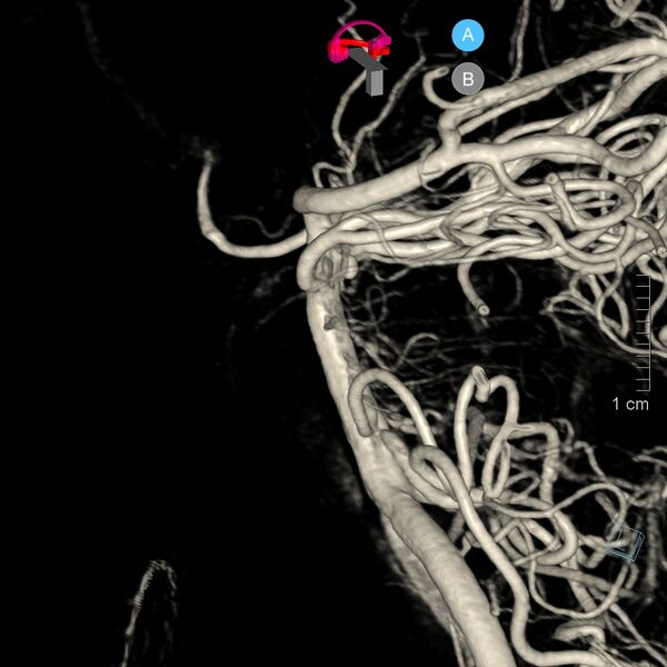 File:Basilar artery perforator aneurysm (Radiopaedia 82455-97734 3D view left VA 18).jpg