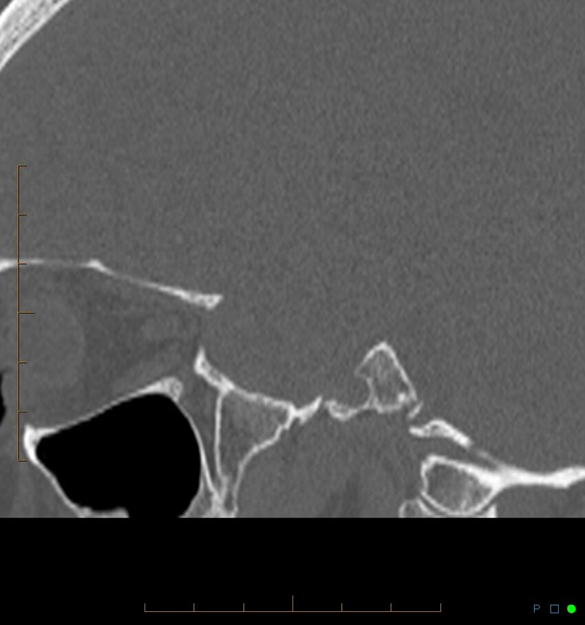 Benign notochordal cell tumor (probable) (Radiopaedia 65475-74546 Sagittal bone window 47).jpg