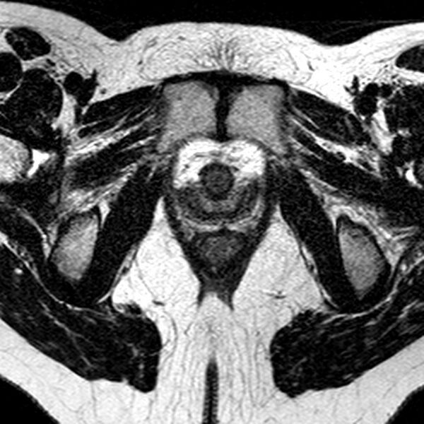 File:Bicornuate uterus (Radiopaedia 11104-11492 Axial T2 6).jpg