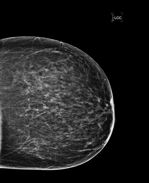 File:Bilateral accessory breast tissue (Radiopaedia 54239-60437 Left CC 1).jpg