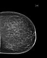 Bilateral accessory breast tissue (Radiopaedia 54239-60437 Left CC 1).jpg