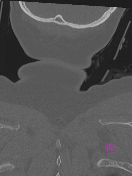 File:Bilateral atlanto-occipital assimilation (Radiopaedia 28350-28603 Coronal bone window 56).jpg