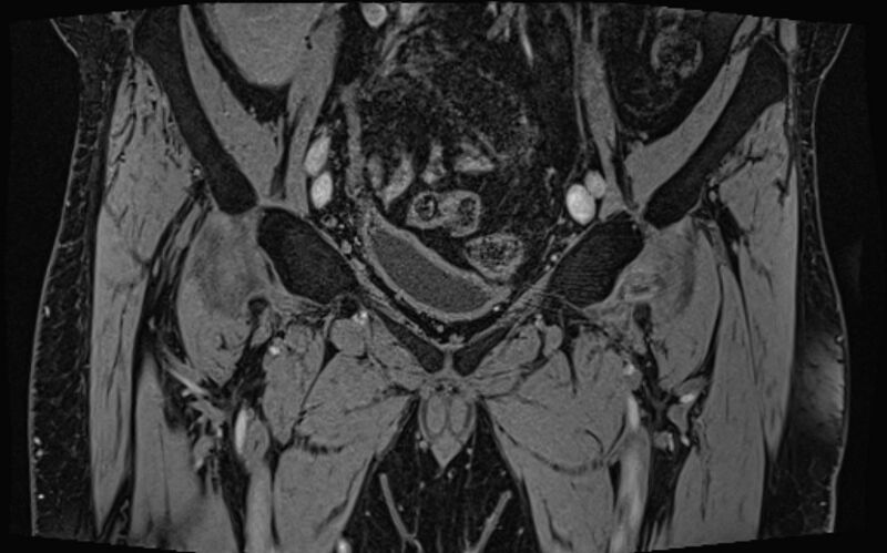 File:Bilateral avascular necrosis of femoral head (Radiopaedia 77116-89078 Coronal T2 we 75).jpg