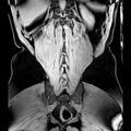 Bilateral conjoined nerve roots at different levels (Radiopaedia 73312-84063 Coronal WE 49).jpg