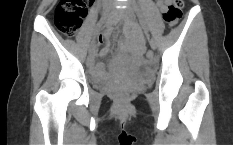File:Bilateral mature cystic ovarian teratoma (Radiopaedia 88821-105592 Coronal non-contrast 10).jpg