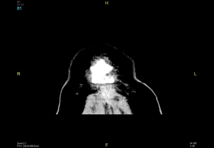 Bilateral medial medullary infarction (Radiopaedia 42220-45295 Coronal non-contrast 61).jpg