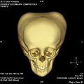 Bilateral ossified cephalohematomas (Radiopaedia 35830).jpg