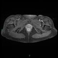 Bilateral ovarian fibroma (Radiopaedia 44568-48293 Axial T1 C+ fat sat 28).jpg