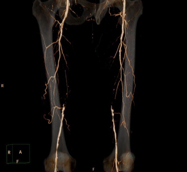 File:Bilateral superficial femoral arterial occlusion (Radiopaedia 25682-25857 3D VR 2).jpg