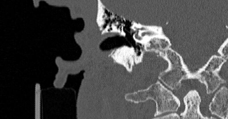 File:Bilateral temporal bone fractures (Radiopaedia 29482-29970 Coronal non-contrast 106).jpg