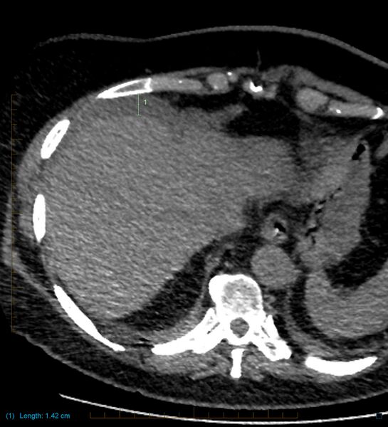 File:Bile leak from accessory duct(s) of Luschka post cholecystectomy (Radiopaedia 40736-43389 A 4).jpg