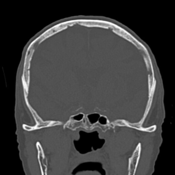 File:Biparietal osteodystrophy (Radiopaedia 46109-50463 Coronal bone window 47).jpg