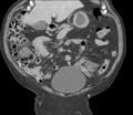 Bladder papillary urothelial carcinoma (Radiopaedia 48119-52951 C 25).png
