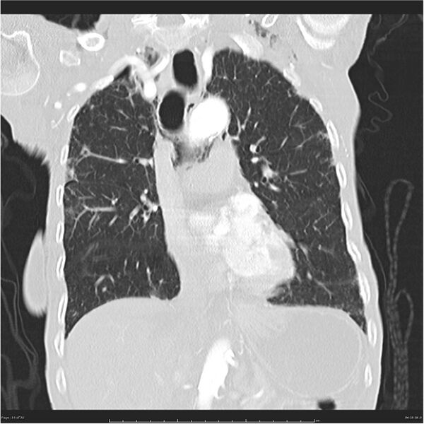 File:Boerhaave syndrome (Radiopaedia 26240-26362 Coronal lung window 14).jpg