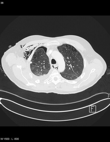 File:Boerhaave syndrome with tension pneumothorax (Radiopaedia 56794-63605 Axial lung window 18).jpg