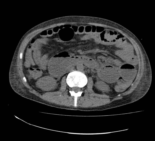 File:Bowel lymphoma complicated by bleeding after therapy (Radiopaedia 55601-62110 Axial non-contrast 38).jpg