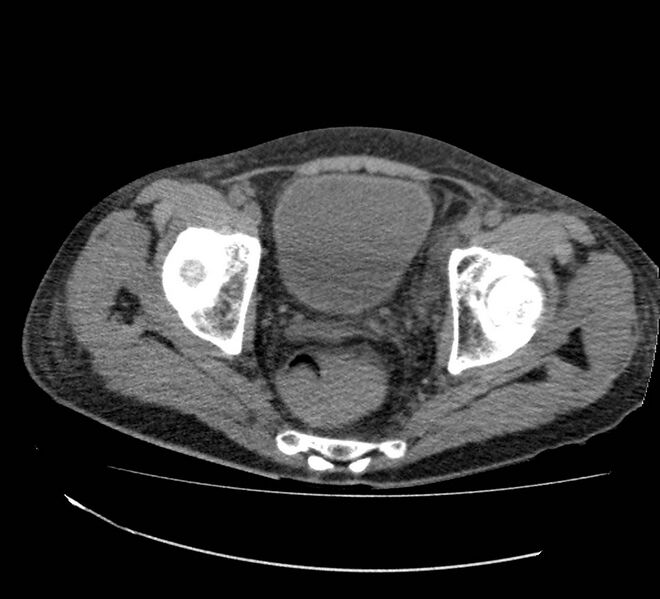 File:Bowel lymphoma complicated by bleeding after therapy (Radiopaedia 55601-62110 Axial non-contrast 74).jpg