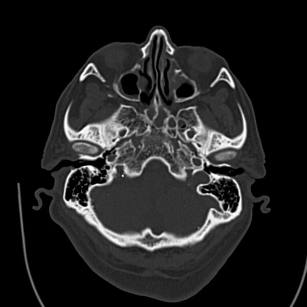 File:Brain Pantopaque remnants (Radiopaedia 78403-91048 Axial bone window 19).jpg