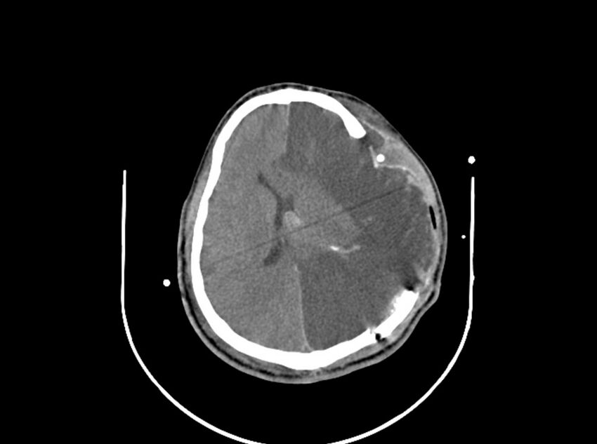 Brain injury by firearm projectile (Radiopaedia 82068-96087 B 120).jpg