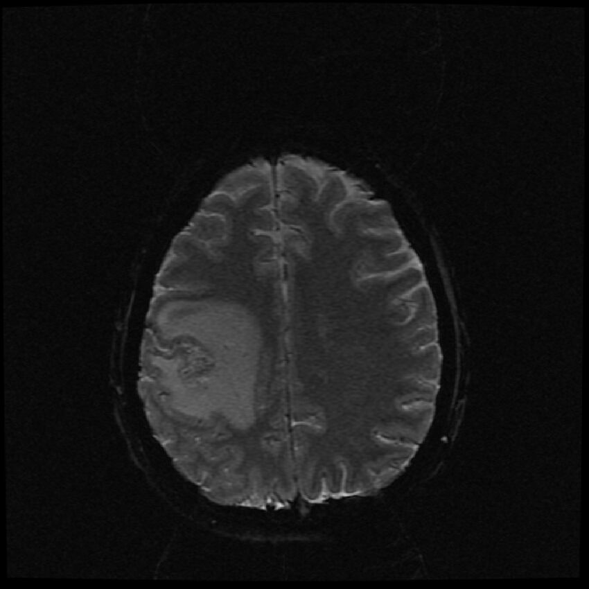 Brain metastases (renal cell carcinoma) (Radiopaedia 42571-45704 Axial SWI 15).jpg