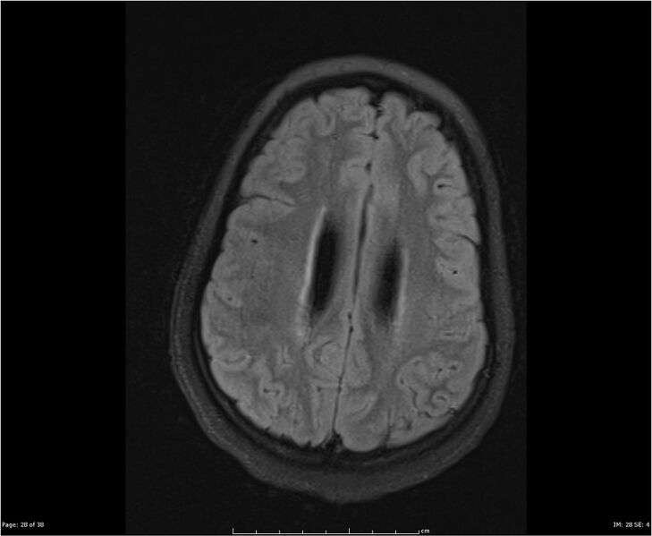 File:Brainstem glioma (Radiopaedia 21819-21775 Axial FLAIR 28).jpg