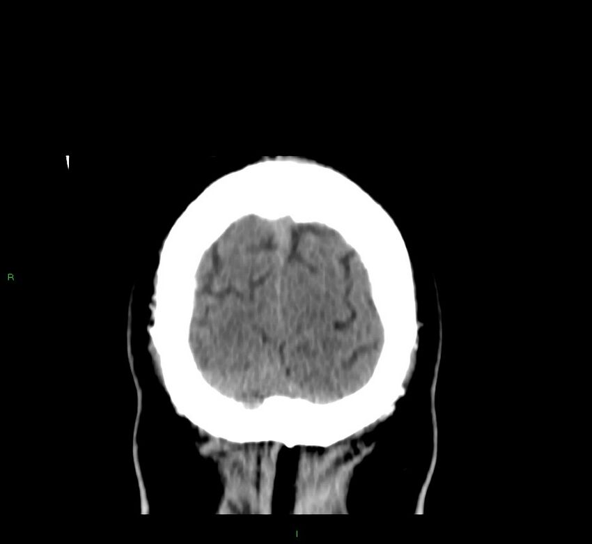 Brainstem hemorrhage (Radiopaedia 58794-66028 Coronal non-contrast 9).jpg