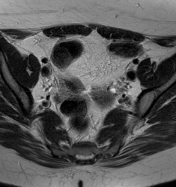 File:Broad ligament leiomyoma (Radiopaedia 81634-95516 Axial T2 9).jpg