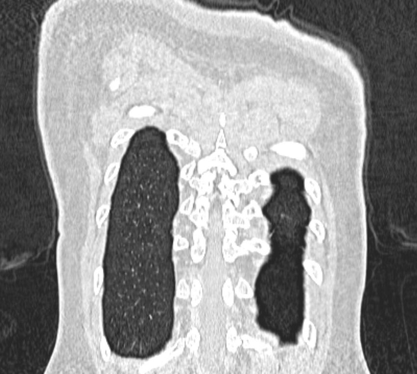 Bronchial atresia (Radiopaedia 50007-55297 Coronal lung window 109).jpg