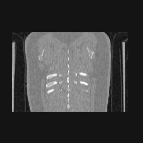 File:Bronchial atresia (Radiopaedia 60685-68439 Coronal lung window 2).jpg