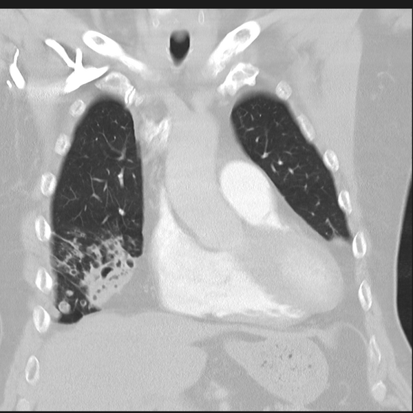 File:Bronchiectasis (Radiopaedia 39385-41666 Coronal lung window 9).png