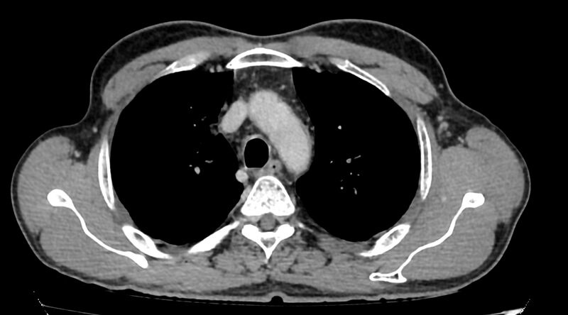 File:Bronchogenic carcinoma with superior vena cava syndrome (Radiopaedia 36497-38054 Axial C+ delayed 25).jpg