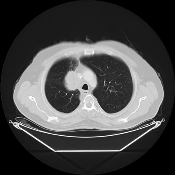 File:Bronchogenic carcinoma with upper lobe collapse (Radiopaedia 29297-29726 Axial lung window 11).jpg